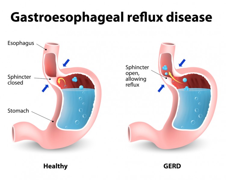 Sleeping with Acid Reflux and Sleep Apnea in Plano